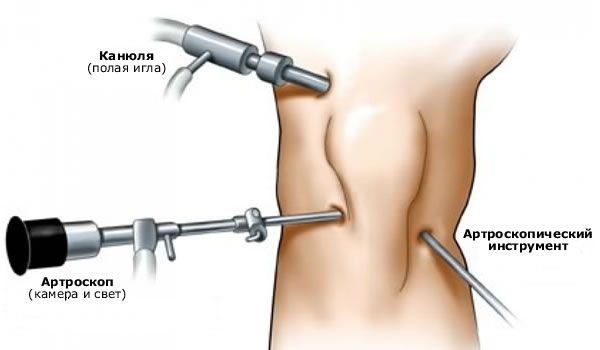 Artroskopia kolenného kĺbu