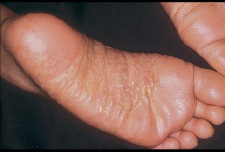 Dermatitída nôh a jej príčiny