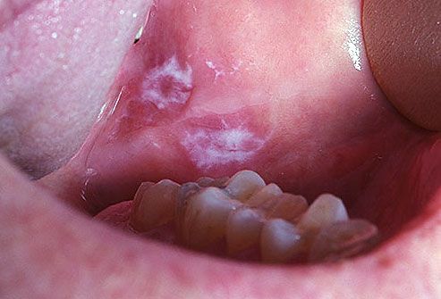 leukoplakia