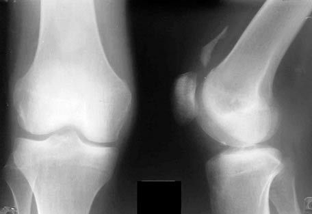Röntgen kolenného kĺbu
