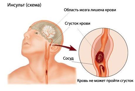 Jednoduchý test predpovedá smrteľný úder