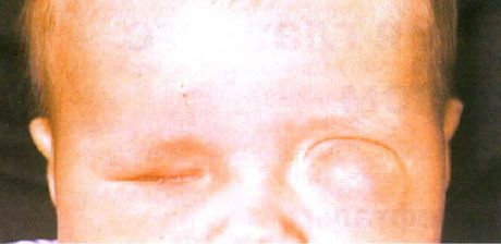 Mikroftalmus so sprievodnou tvorbou cysty (ľavé oko).  Anophthalmus (pravé oko).