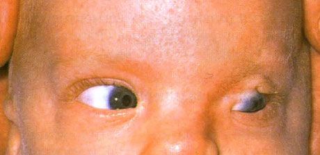 Fraserov syndróm.  Neúplný kryptoftalmus ľavého oka.