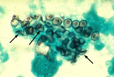 Kauzálny agens pneumocystis (Pneumocystis jiroveci)