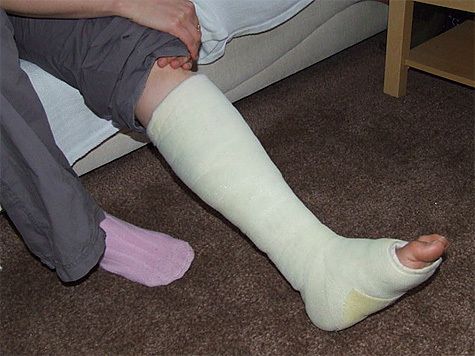 Opatrenia doma s zlomeninou nohy