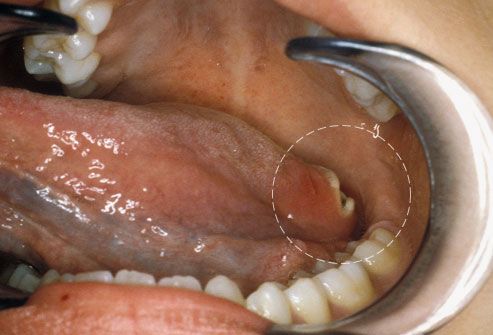 Rakovina ústnej dutiny
