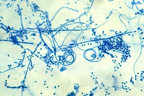 Príčinou vzniku epidermofytózy nohy (Trichophyton interdigitale)