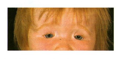 Obojstranný kolobóm očných viečok u dieťaťa s malým syndrómom.  Uzavretie očného štrbiny vľavo